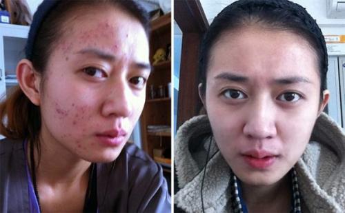 Acne Treatment Acne Treatment