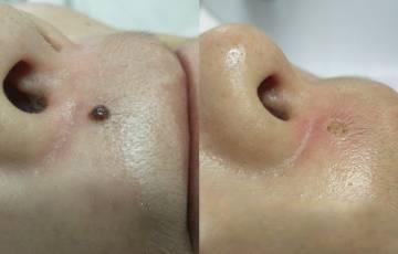 Pigment Removal Pigment Removal